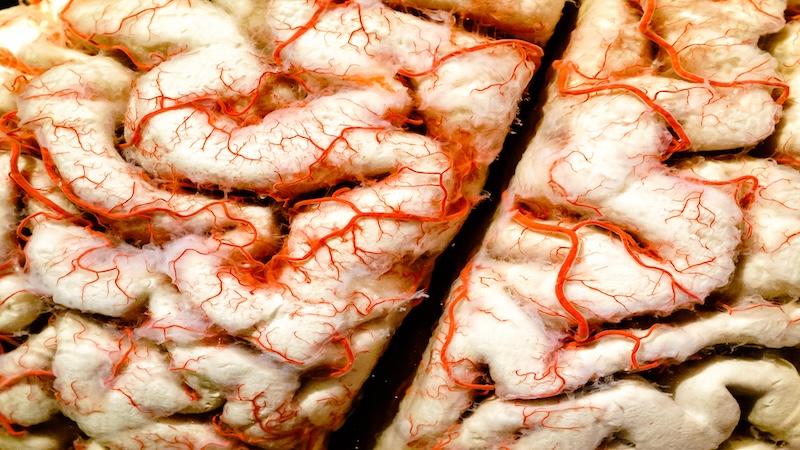 Cerebrovascular.jpg